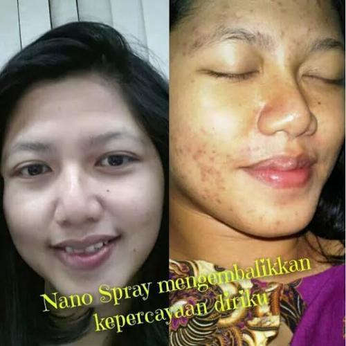testimoni nanospray 14