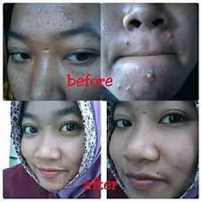 testimoni nanospray 20