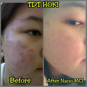 testimoni nanospray 25