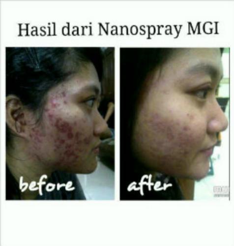 testimoni nanospray 6