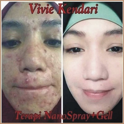 testimoni nanospray 8